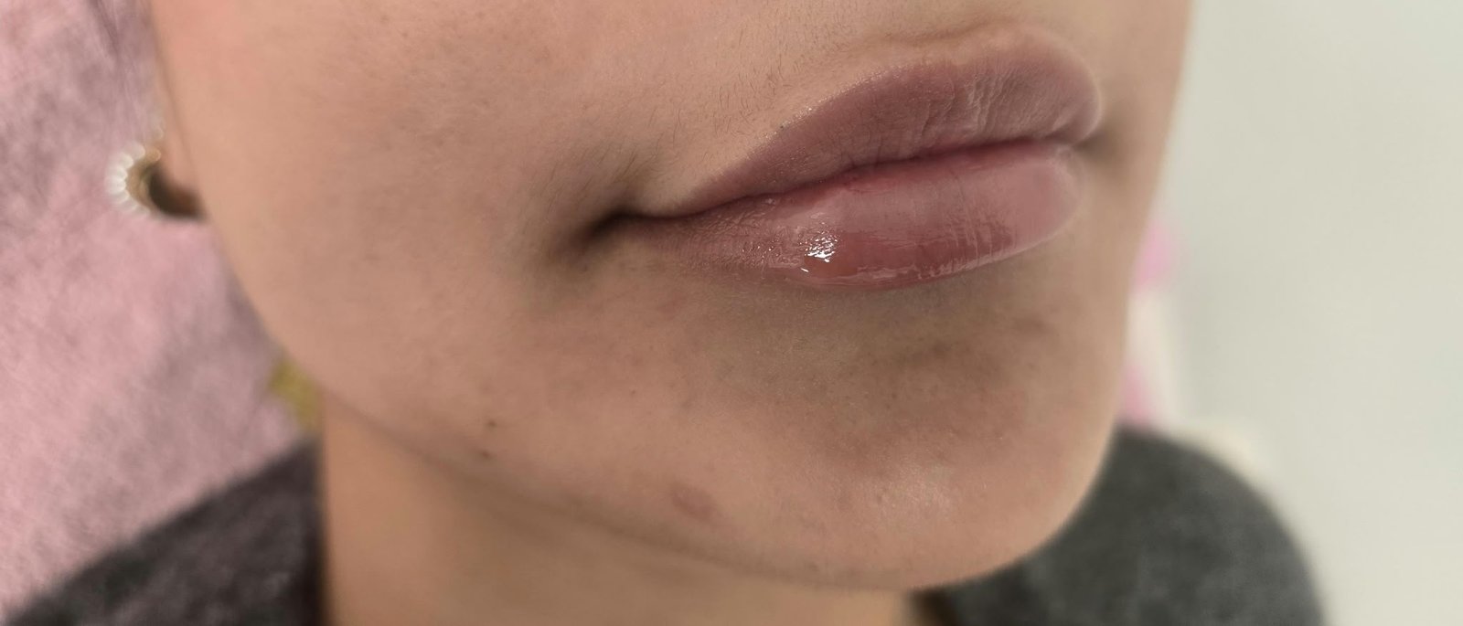 قبل العلاج